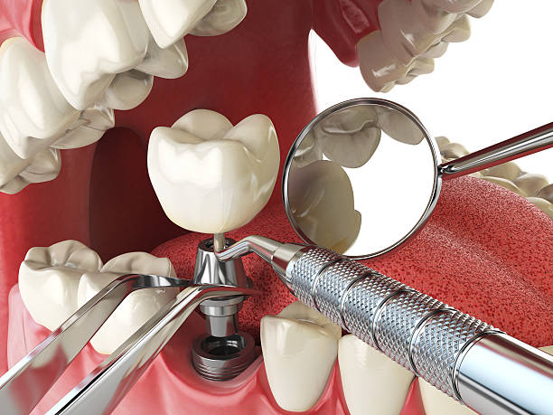Best Emergency Denture Repair in Taneytown, MD